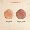 Abhyud Face Oil For Acne Prone Skin