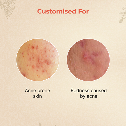 Abhyud Face Oil For Acne Prone Skin